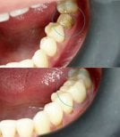 Before and after dental crown installation at Dental Bliss, restored molar tooth result