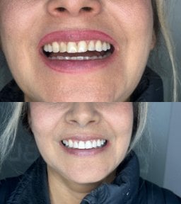 Before and after smile makeover results at Dental Bliss – improved teeth alignment and whiteness