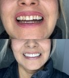 Before and after smile makeover results at Dental Bliss – improved teeth alignment and whiteness