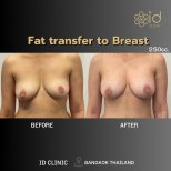 Результати ліпофілінгу грудей в ID Clinic Bangkok, природне збільшення грудей