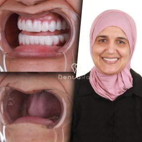 Resultado de implantes dentales All-on-4 en Dentaray Clinic: sonrisa restaurada y dientes nuevos