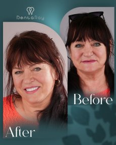 Resultado antes y después de implantes dentales All-on-4 en Dentaray Clinic, sonrisa mejorada