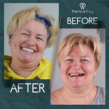 Resultado antes y después de implantes dentales All-on-4 en Dentaray Clinic, sonrisa restaurada