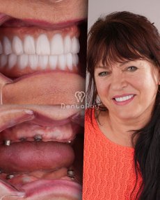 Resultados de implantes dentales All-on-4 antes y después en Dentaray Clinic, sonrisa restaurada