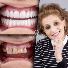 Resultados de implantes dentales All-on-4 antes y después en Dentaray Clinic, restauración de sonrisa