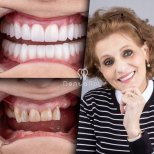 Resultados de implantes dentales All-on-4 antes y después en Dentaray Clinic, restauración de sonrisa