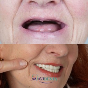 before-after photo all-on-6-dental-implants