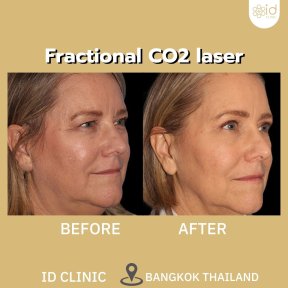 before-after photo fillers-injection