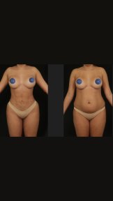 before-after photo 360-liposuction