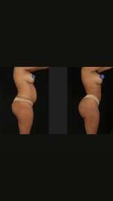 before-after photo 360-liposuction