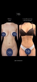 before-after photo 360-liposuction