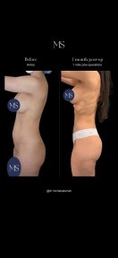 before-after photo 360-liposuction