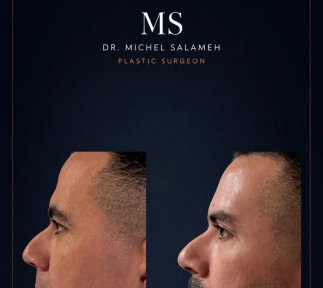 before-after photo tightening-of-facial-skin-facelift