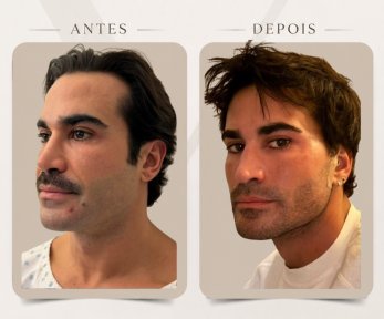 before-after photo tightening-of-facial-skin-facelift