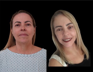 before-after photo tightening-of-facial-skin-facelift