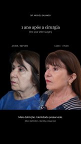 before-after photo tightening-of-facial-skin-facelift