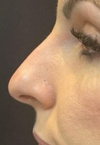 before-after photo rhinoplasty-nose-job
