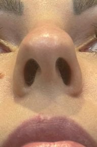 before-after photo rhinoplasty-nose-job