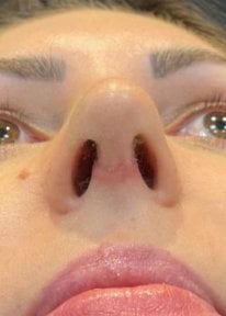 before-after photo rhinoplasty-nose-job
