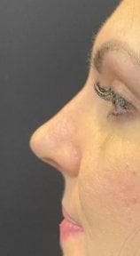 before-after photo rhinoplasty-nose-job
