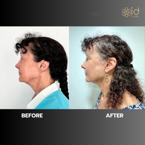 before-after photo tightening-of-facial-skin-facelift