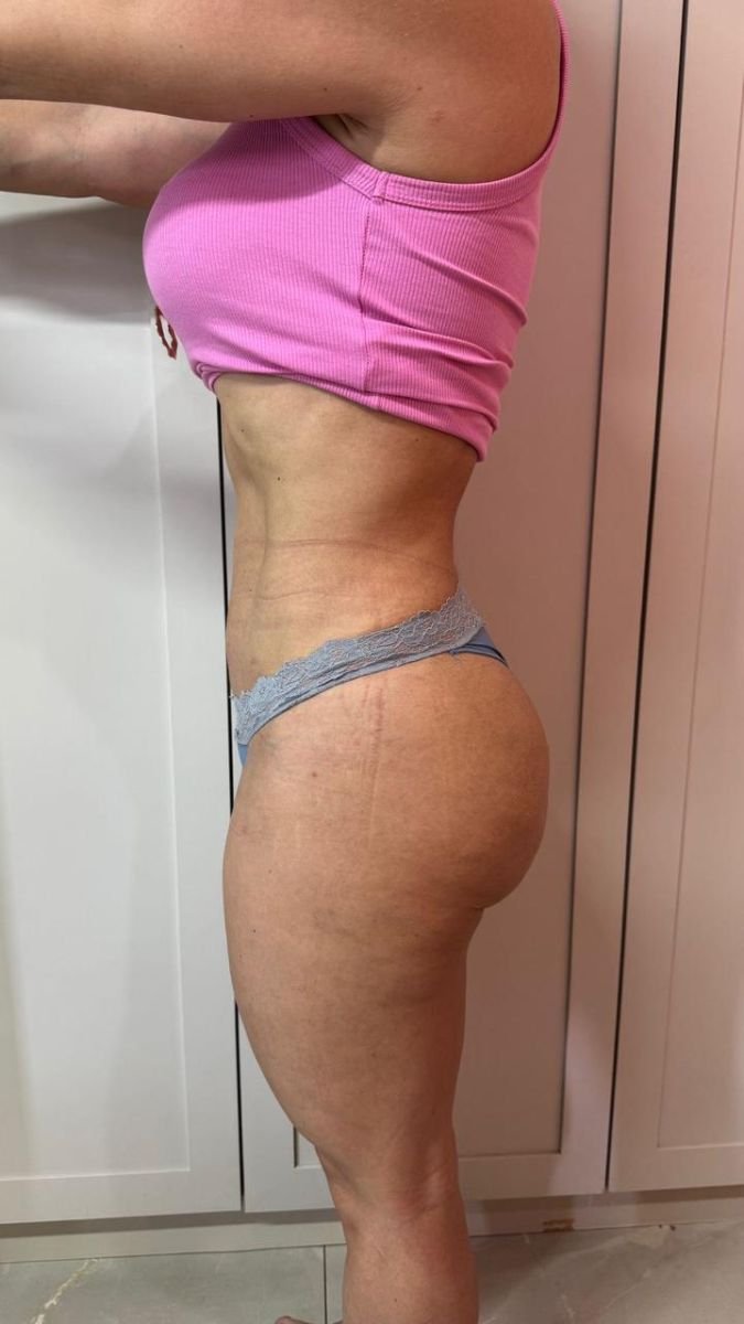 before-after photo