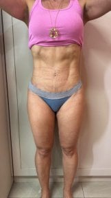 before-after photo liposuction-2-3-body-areas
