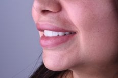 Résultat implant dentaire chez Dentaland Premium Luxury Clinic & Academy, sourire naturel
