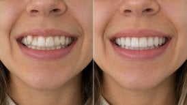 Результаты до и после брекетов для взрослых в Punta Cana dentist odontologia familiar, улучшенная улыбка