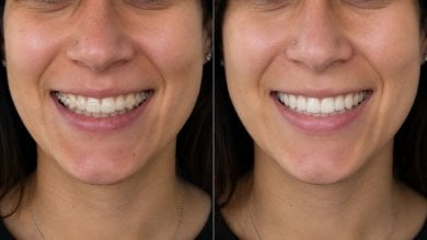 Результат до и после брекетов для взрослых в Punta Cana dentist odontologia familiar, улыбка