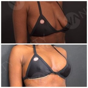 Before and after breast augmentation results at Vanity Cosmetic Surgery Center, fuller breasts