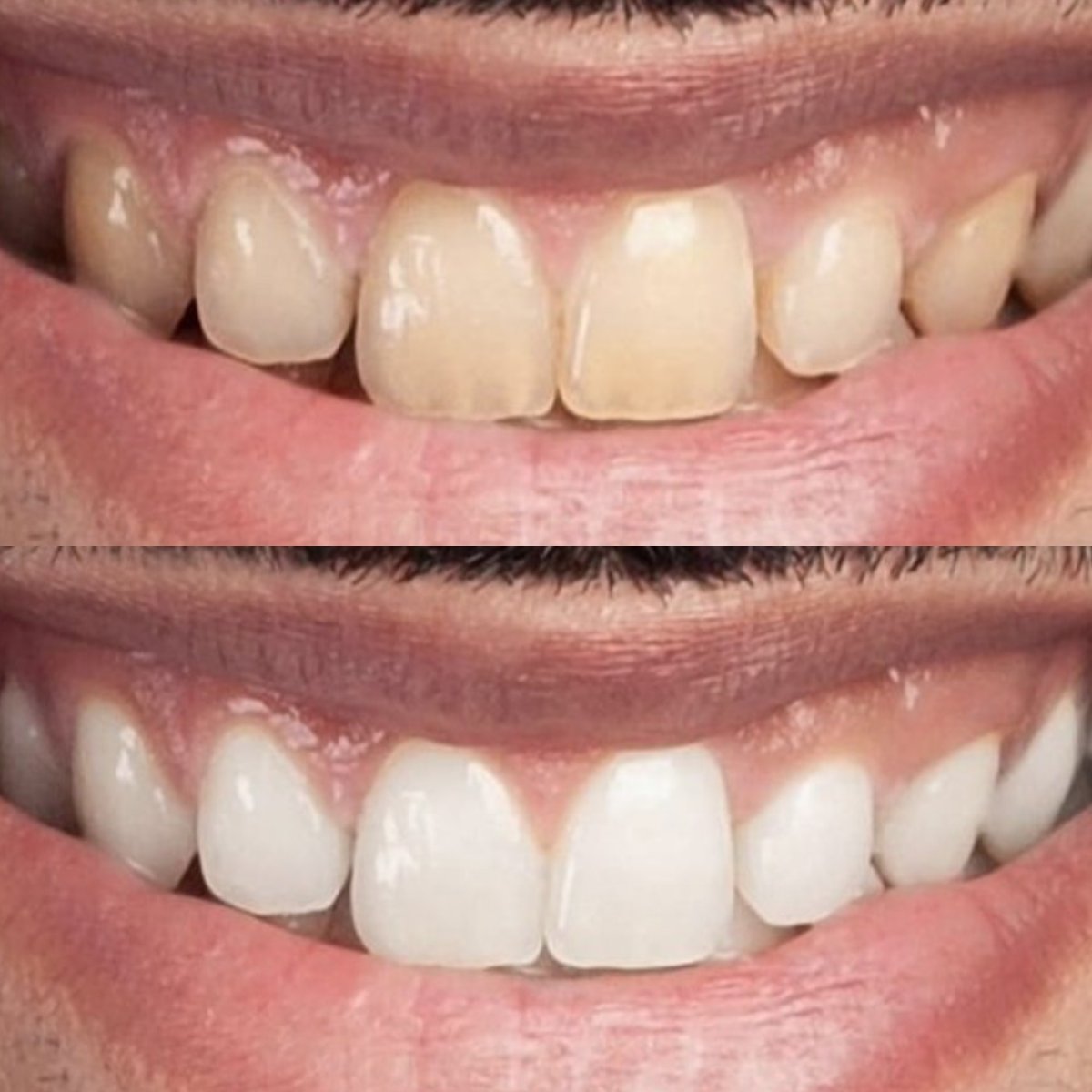 Resultados de blanqueamiento dental antes y después en Punta Cana dentist odontologia familiar
