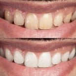 Efekty wybielania zębów przed i po w Punta Cana dentist odontologia familiar, jaśniejszy uśmiech