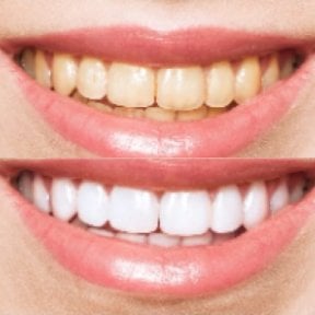 Efekty przed i po wybielaniu zębów w Punta Cana dentist odontologia familiar, jaśniejszy uśmiech