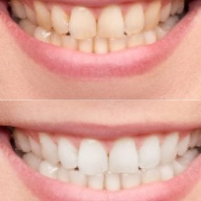 Efekty wybielania zębów przed i po w Punta Cana dentist odontologia familiar, jaśniejszy uśmiech