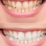 Efekty wybielania zębów przed i po w Punta Cana dentist odontologia familiar, jaśniejszy uśmiech
