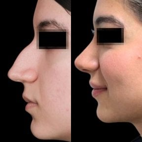 before-after photo rhinoplasty-nose-job