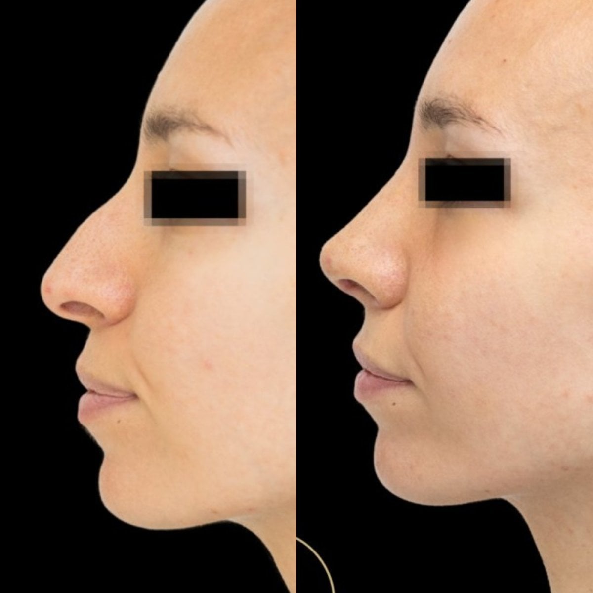 نتائج عملية تجميل الأنف قبل وبعد في EDEN AESTHETICS، إعادة تشكيل طبيعي للأنف