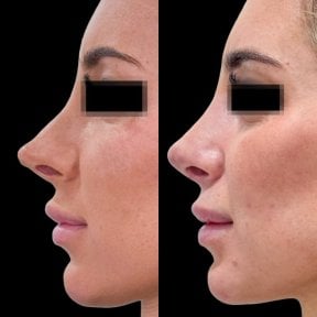 before-after photo rhinoplasty-nose-job