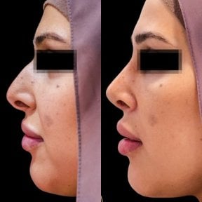 before-after photo rhinoplasty-nose-job