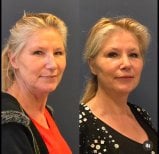 Before and after Lipofilling (Fat Grafting) photos by Dr. 