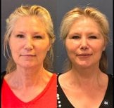 Before and after Lipofilling (Fat Grafting) photos by Dr. 
