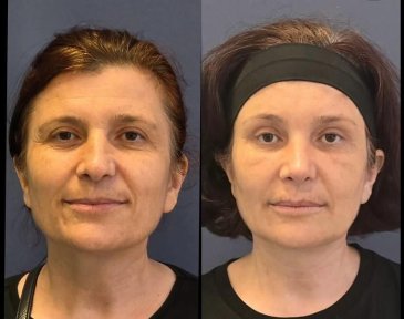 before-after photo lipofilling