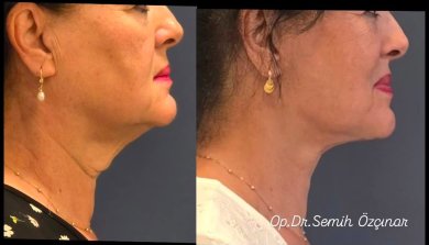 before-after photo lipofilling