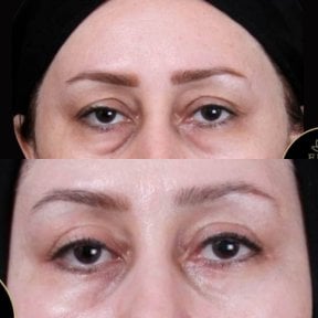 before-after photo blepharoplasty-eyelid