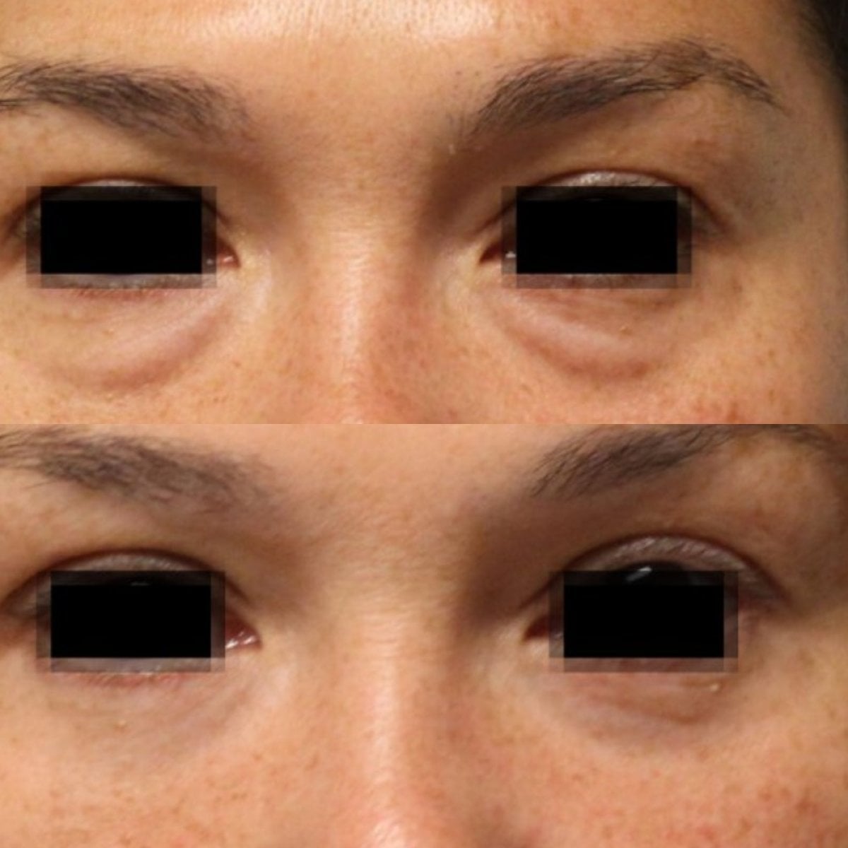 نتائج قبل وبعد جراحة الجفن في EDEN AESTHETICS، تصحيح الجفون وتنعيم تحت العين