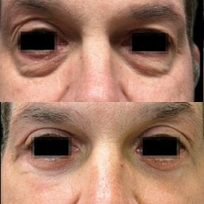 before-after photo blepharoplasty-eyelid
