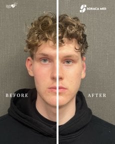 Before and after otoplasty results at Soraca Med, improved ear shape and symmetry