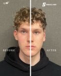 Before and after otoplasty results at Soraca Med, improved ear shape and symmetry