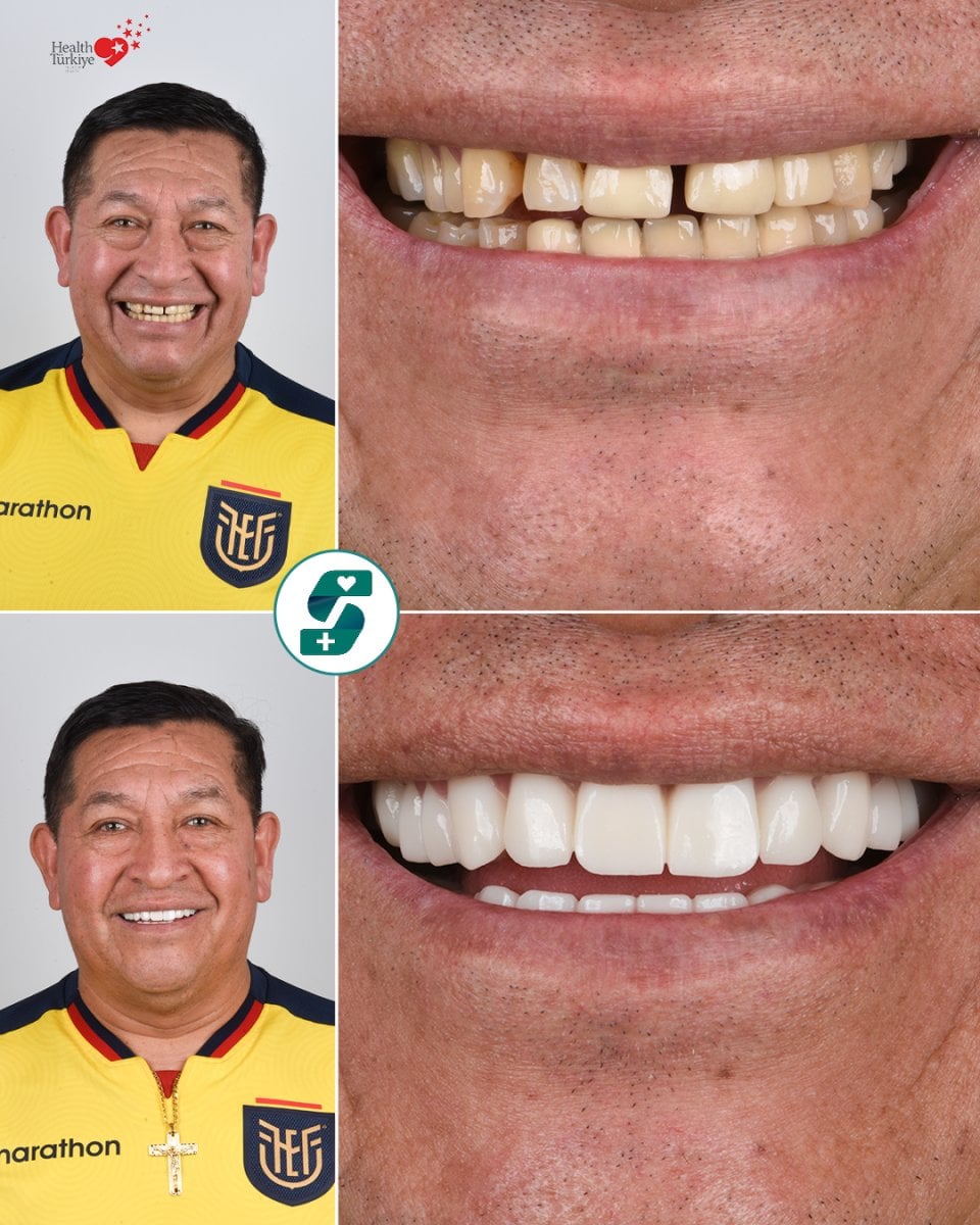 before-after photo
